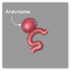 Surmonter Les Symptomes Severes De L Anevrisme Cerebral Cerveau